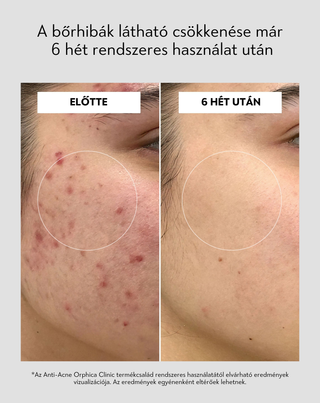 Tisztító és regeneráló arcmaszk aknés bőrre fehér agyaggal Anti-Acne Orphica Clinic 100 ml - 5