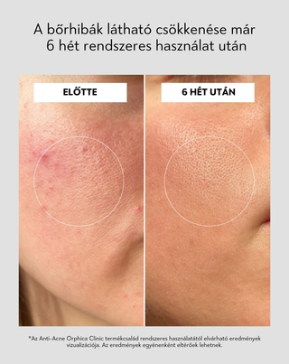 Pattanáselleni nappali arckrém szalicilsavval és azelainsavval a bőrhibákra Anti-Acne Orphica Clinic 50 ml - 5