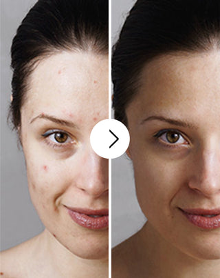 Derminax pattanások, akné és bőrhibák elleni tabletta cinkkel, C, E és B2 vitaminnal_3 - 3