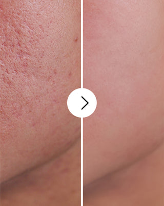 Derminax pattanások, akné és bőrhibák elleni tabletta cinkkel, C, E és B2 vitaminnal_4 - 4