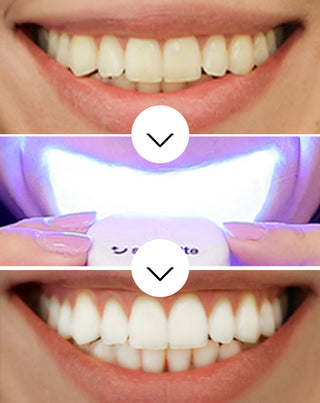 Smilebite fogfehérítő készlet LED lámpával és fehérítő zselével - 3