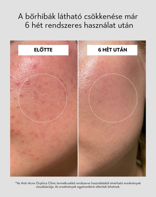 Toner niacinamiddal és azelainsavval Anti-Acne Orphica Clinic 200 ml - 6